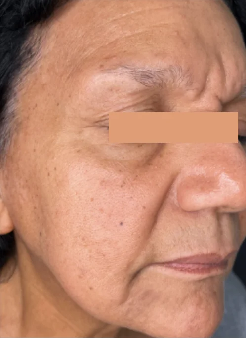 Patient after CO2 laser resurfacing showing smoother skin