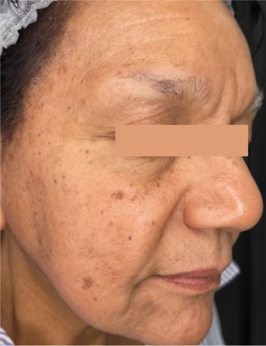 Patient before CO2 laser resurfacing treatment