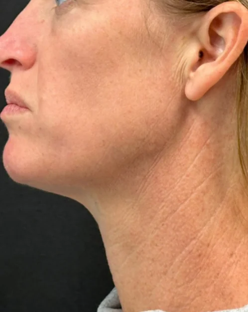 Patient after Crow's Feet showing smoothed naturally