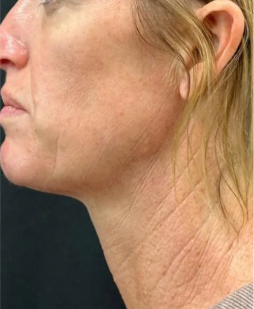 Patient before Crow's Feet treatment at IRIS Aesthetics