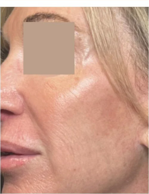 Patient after 11 Lines showing relaxed appearance