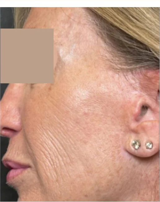 Patient before 11 Lines treatment at IRIS Aesthetics