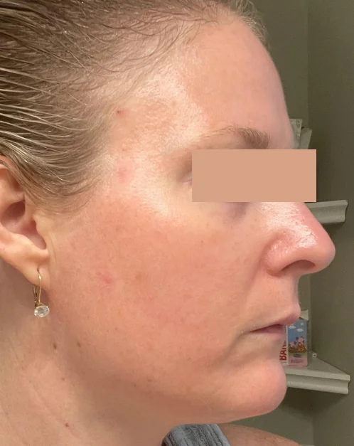 Patient after Lower Blepharoplasty showing smoothed under-eyes