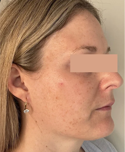 Patient before Lower Blepharoplasty treatment at IRIS Aesthetics