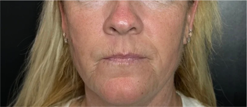 Patient after Neck Lift showing defined jawline