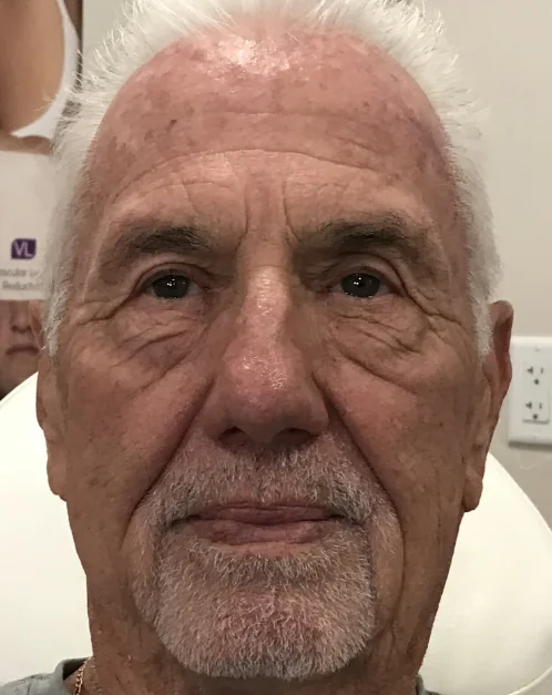Patient after Botox and filler treatment showing natural rejuvenation