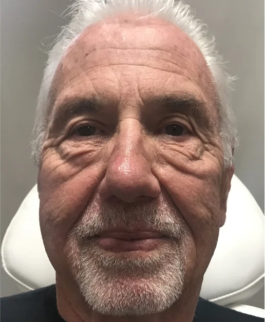 Patient before Botox and filler treatment
