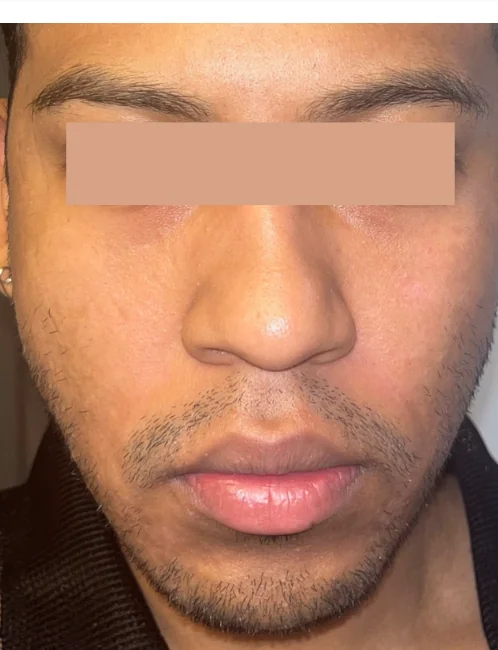 Patient after Upper & Lower showing total eye rejuvenation