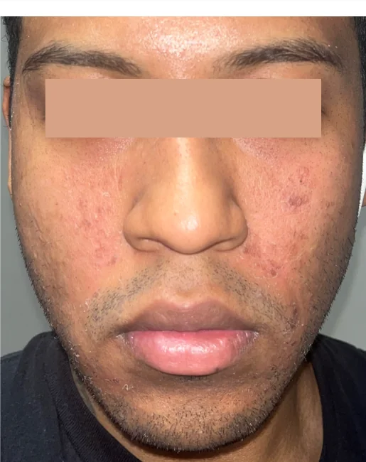 Patient before Upper & Lower treatment at IRIS Aesthetics
