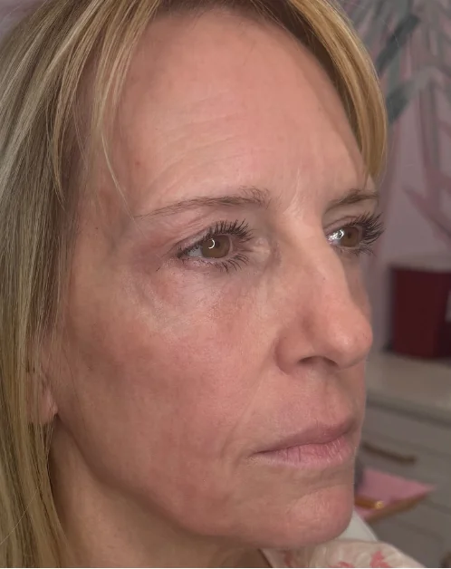 Patient after Combined Lift showing refined facial contours