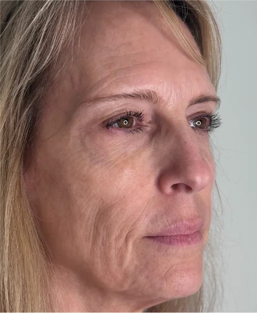 Patient before Combined Lift treatment at IRIS Aesthetics