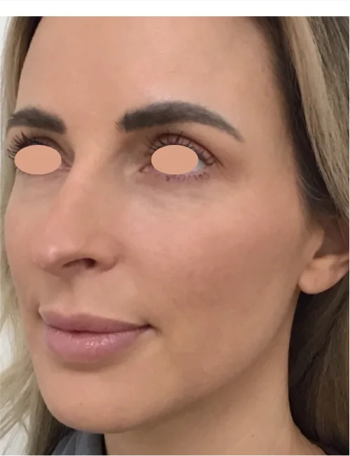 Patient after Level 2 Peel showing smoother, even tone