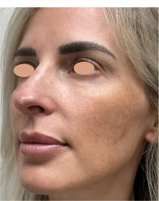 Patient before Level 2 Peel treatment at IRIS Aesthetics