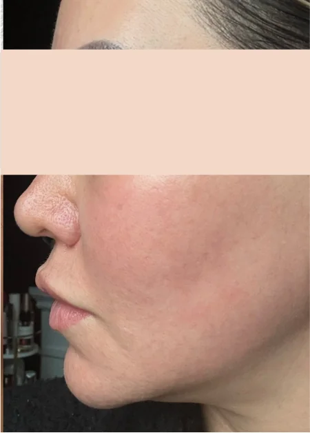 Patient after Full-Face CO2 showing resurfaced and smoothed
