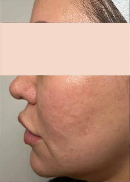 Patient before Full-Face CO2 treatment at IRIS Aesthetics