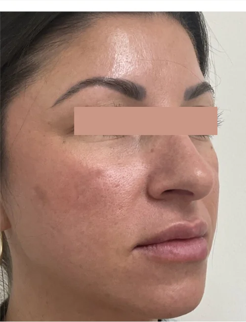 Patient after eyelid surgery showing refreshed, open eyes