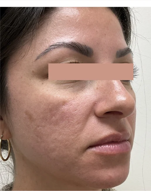 Patient before eyelid surgery