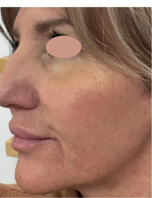 Patient after CO2 Series showing reduced sun damage