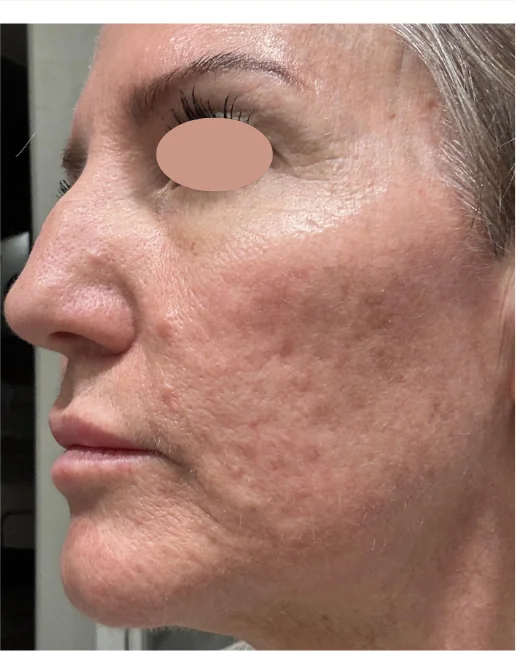 Patient before CO2 Series treatment at IRIS Aesthetics