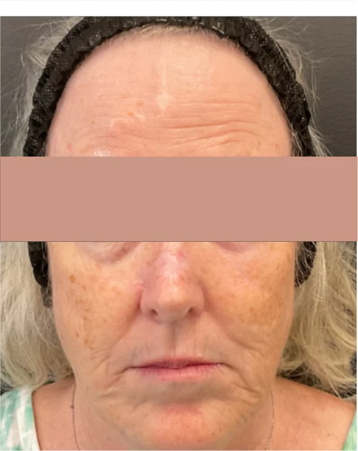 Patient before Lip Fillers treatment at IRIS Aesthetics