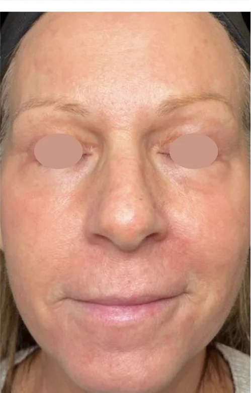 Patient after Tear Trough showing brighter under-eyes