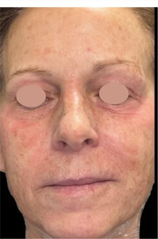 Patient before Tear Trough treatment at IRIS Aesthetics