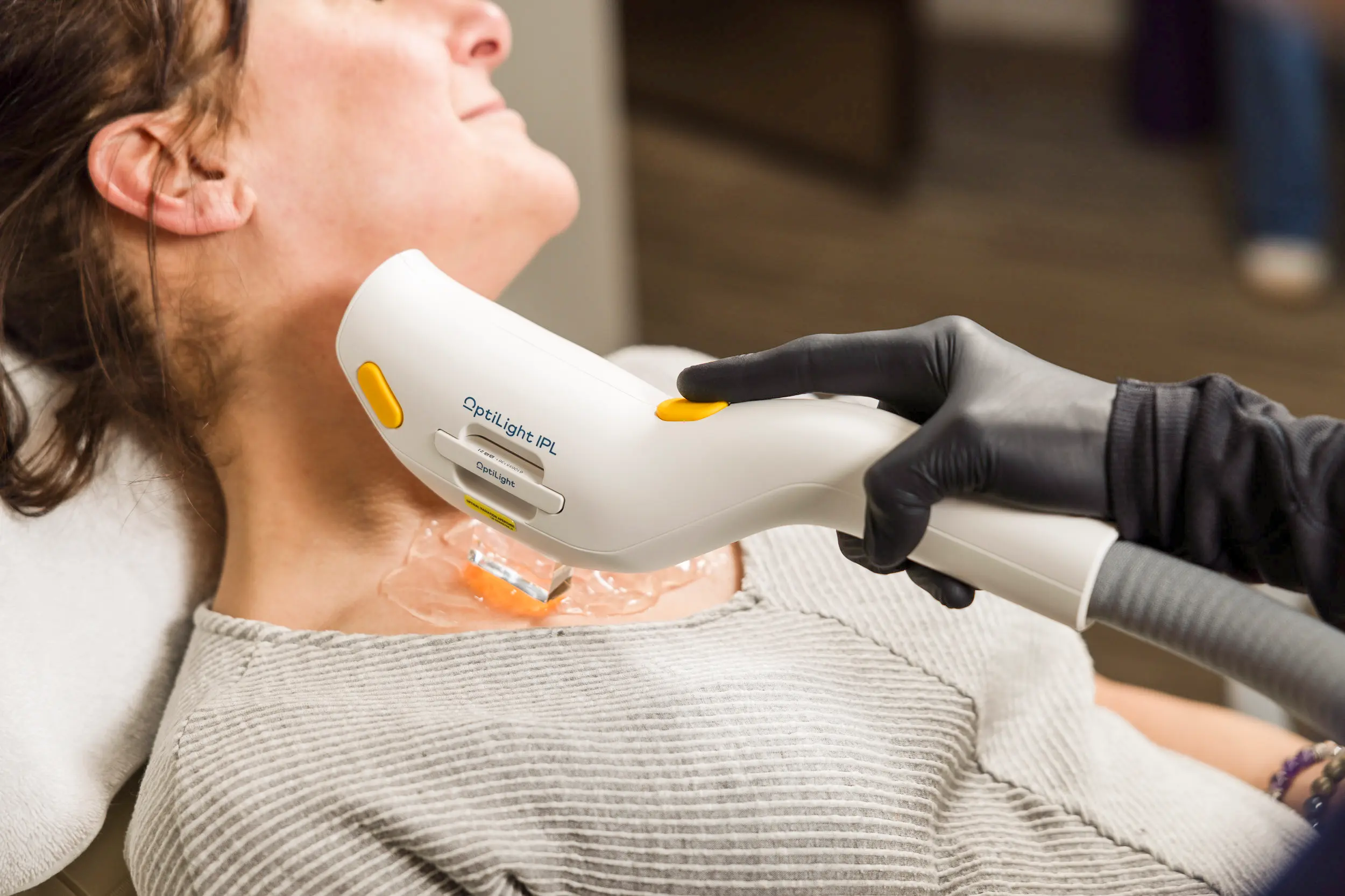 Close-up of IPL photofacial treatment at IRIS Aesthetics