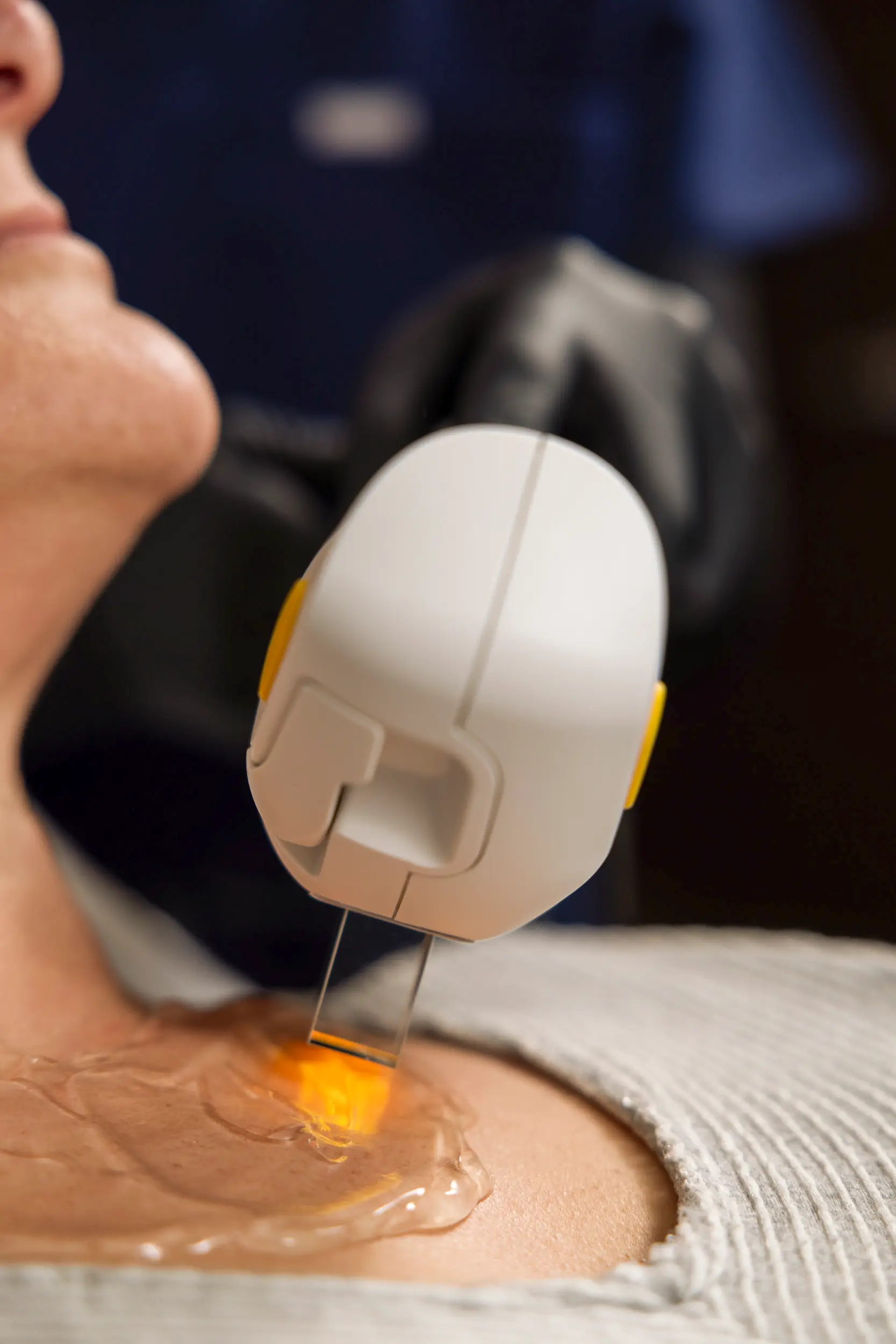 Close-up of laser hair removal treatment at IRIS Aesthetics